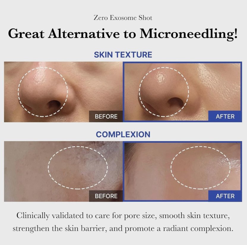 Before and after comparison of skin texture and complexion with text about a 'Zero Exosome Shot' treatment.