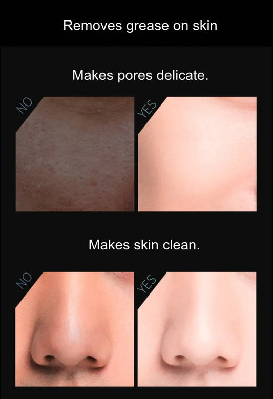 Oil-absorbing volcanic roller for oily T-zones